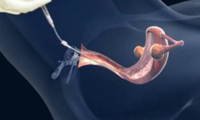 嘉定妇幼保健院不育不孕（嘉定妇幼保健院看不育不孕）